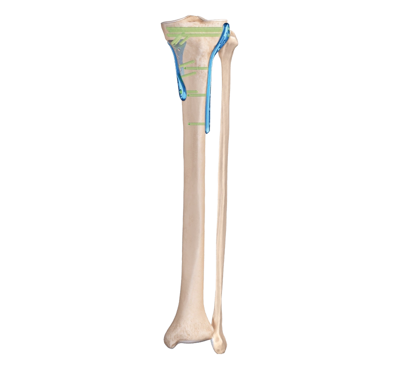 Co28Cr6Mo tibia plato specifoj kaj kongruo